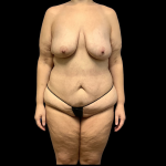 Mommy Makeover Before & After Patient #4368