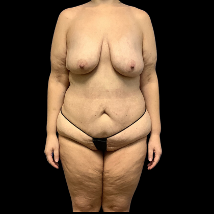 Mommy Makeover Before & After Patient #4368