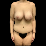 Mommy Makeover Before & After Patient #4368