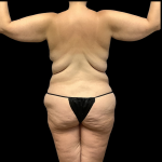 Mommy Makeover Before & After Patient #4368