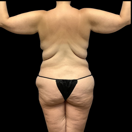Mommy Makeover Before & After Patient #4368