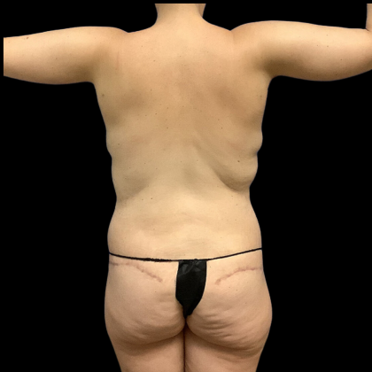 Mommy Makeover Before & After Patient #4368