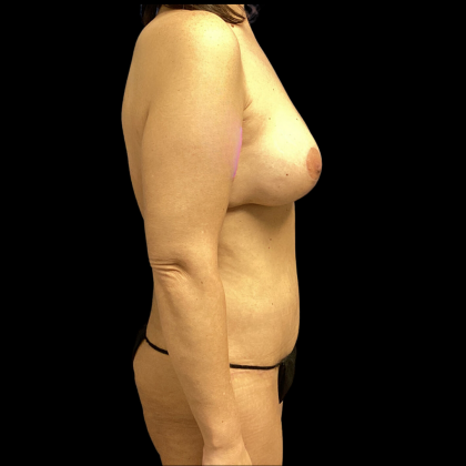 Mommy Makeover Before & After Patient #4371