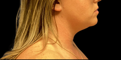 Neck Lift Before & After Patient #4451