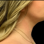 Neck Lift Before & After Patient #4451