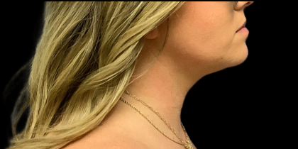 Neck Lift Before & After Patient #4451