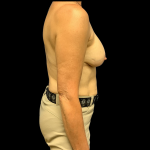 Implant Removal Before & After Patient #4370