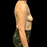Implant Removal Before & After Patient #4370
