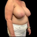 Breast Reduction Before & After Patient #4372