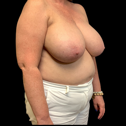 Breast Reduction Before & After Patient #4372