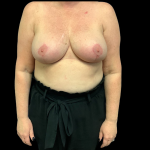Breast Reduction Before & After Patient #4372