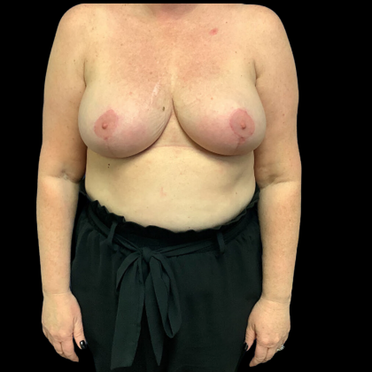 Breast Reduction Before & After Patient #4372