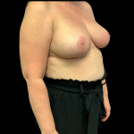 Breast Reduction Before & After Patient #4372