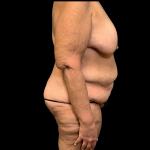 Mommy Makeover Before & After Patient #4373