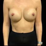 Breast Augmentation Before & After Patient #4367