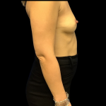Breast Augmentation Before & After Patient #4367