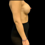 Breast Augmentation Before & After Patient #4367