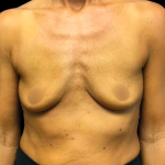 Breast Augmentation Before & After Patient #4025
