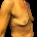 Breast Augmentation Before & After Patient #4025