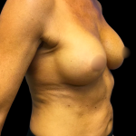 Breast Augmentation Before & After Patient #4025