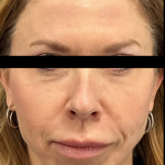 Facelift Before & After Patient #4905