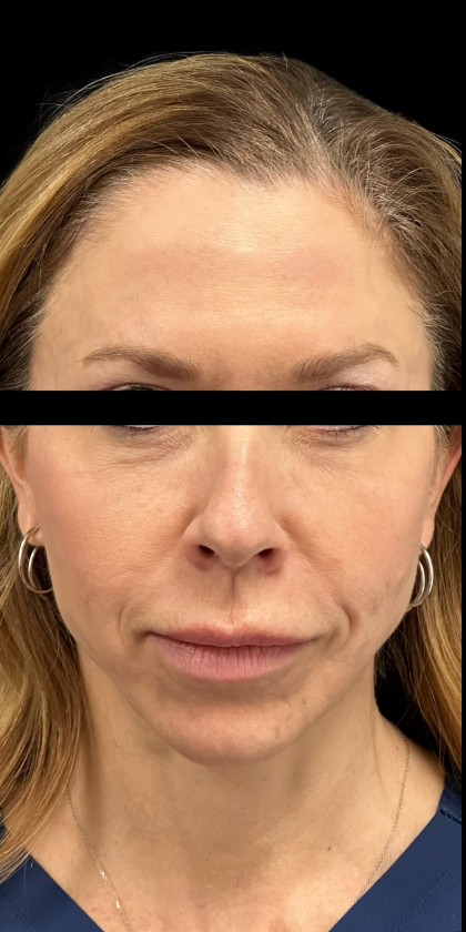 Facelift Before & After Patient #4905