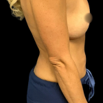 Breast Augmentation Before & After Patient #4949