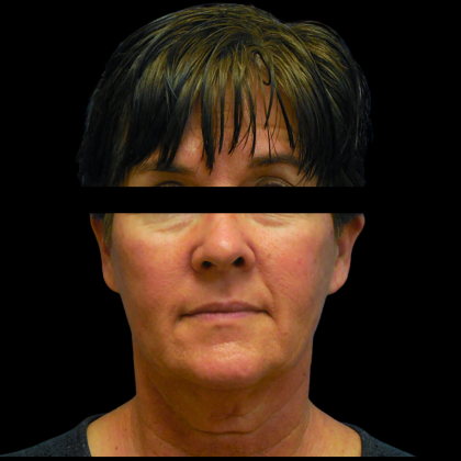 Facelift Before & After Patient #4890