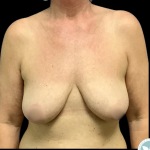 Breast Lift Before & After Patient #4953