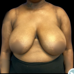 Breast Reduction Before & After Patient #4954