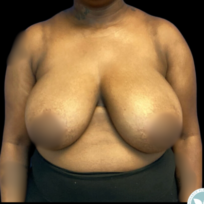 Breast Reduction Before & After Patient #4954