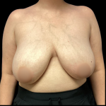 Breast Reduction Before & After Patient #4956