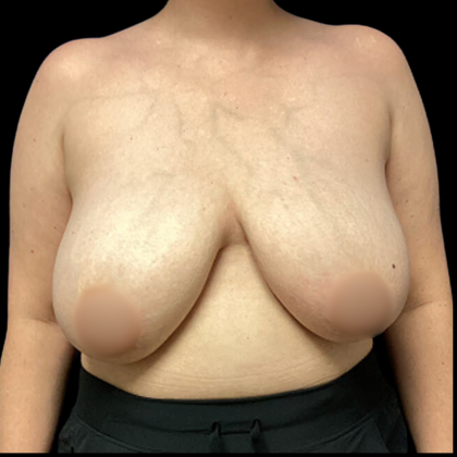 Breast Reduction Before & After Patient #4956