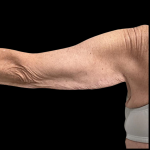 Arm Lift Before & After Patient #4891