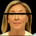 Facelift Before & After Patient #4960