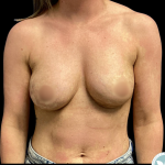 Implant Removal Before & After Patient #4961