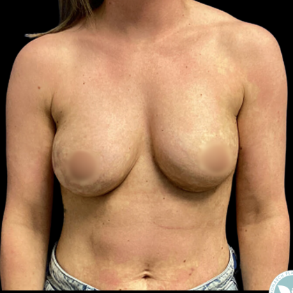 Implant Removal Before & After Patient #4961