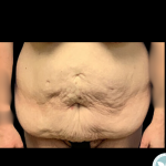 Liposuction Before & After Patient #4962