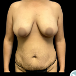 Liposuction Before & After Patient #4963