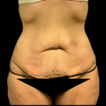Tummy Tuck Before & After Patient #4965
