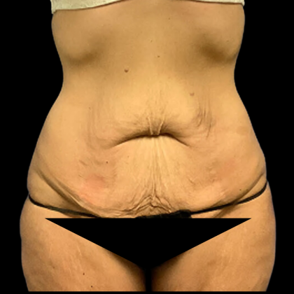 Tummy Tuck Before & After Patient #4965