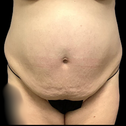 Tummy Tuck Before & After Patient #4968