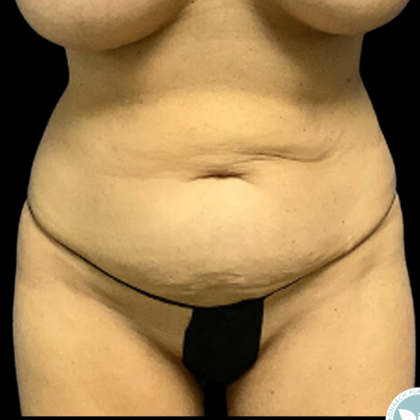Tummy Tuck Before & After Patient #4970