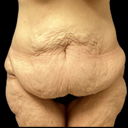 Tummy Tuck Before & After Patient #4972