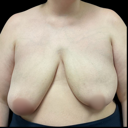 Breast Reconstruction Before & After Patient #4903