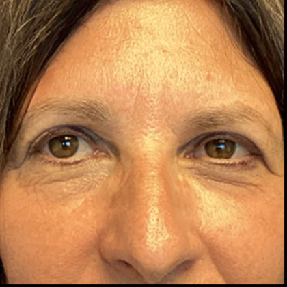 Blepharoplasty Before & After Patient #5079