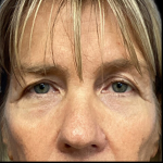 Blepharoplasty Before & After Patient #5080