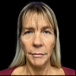 Facelift Before & After Patient #5081