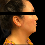 Neck Lift Before & After Patient #5083