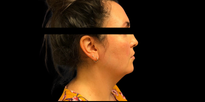 Neck Lift Before & After Patient #5083